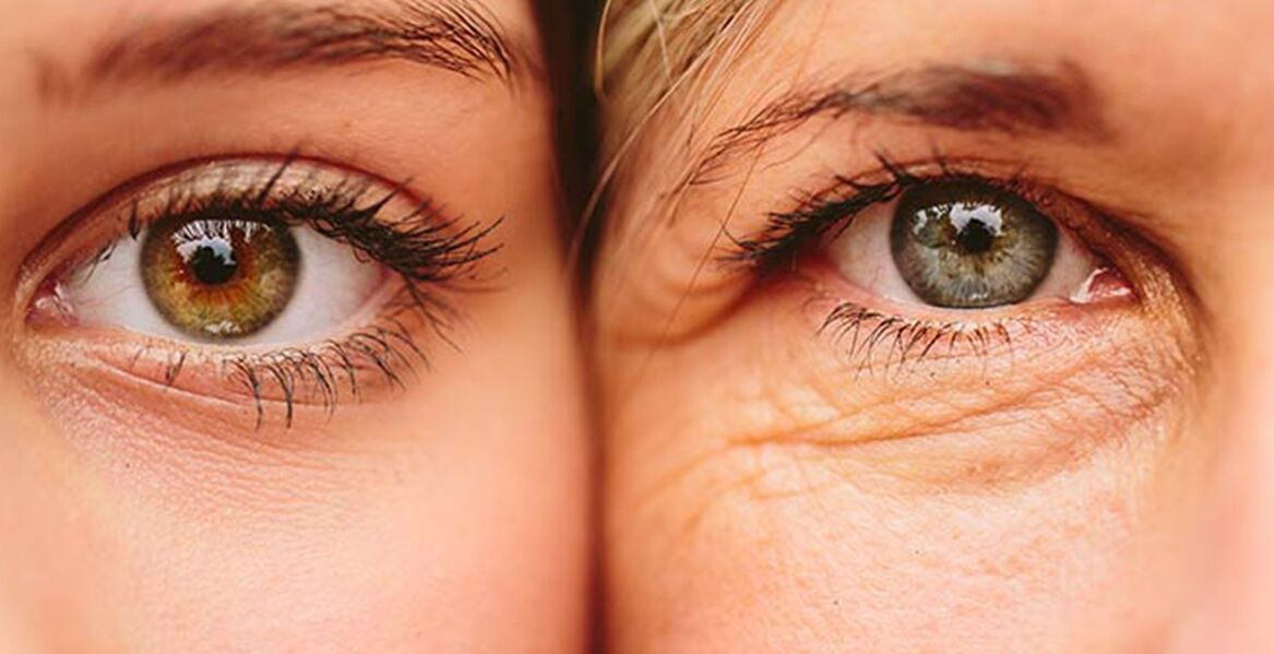 Signes externes de vieillissement cutané autour des yeux chez deux femmes d'âges différents