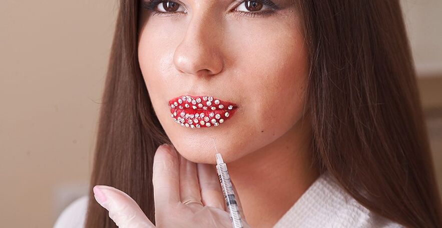 Augmentation et correction esthétique des lèvres avec des produits de comblement