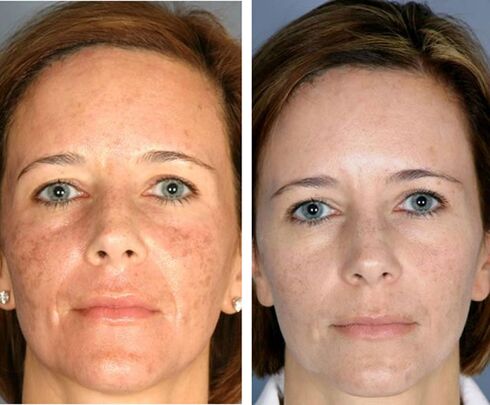 Avant et après la thermolyse faciale fractionnée