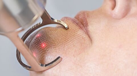 Le déroulement de la procédure de rajeunissement fractionné de la peau du visage au laser