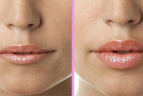 avant et après la restauration des lèvres